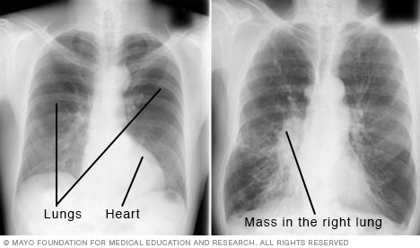 Chest X-rays - Drugs.com